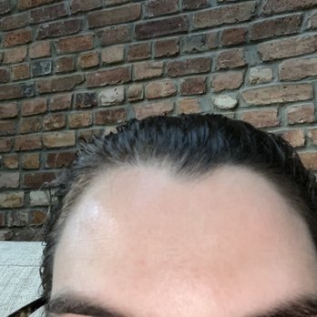 Manhattan Medspa - Forehead after 5 + days - Medical Spas Near Me - New York, New York