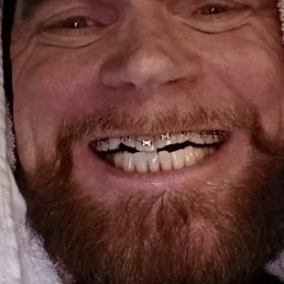 Look at how the back molars would not come together because of the tabs Dr. Luu attached to the back of my front teeth.