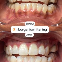 M&B Organic Whitening - Up to 14 shades whiter in one session