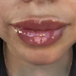 Lip filler