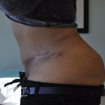 Sean A Wright, MD FACS - Abdominoplasty after side view - Cosmetic Surgeons Near Me - Media, Pennsylvania Sean A Wright, MD FACS - Abdominoplasty after side view - Cosmetic Surgeons Near Me - Media, Pennsylvania