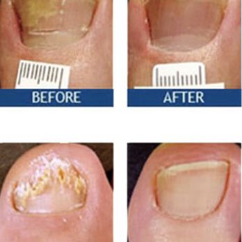 Andrew I Levy, DPM - Laser nail therapy - Podiatrists Near Me