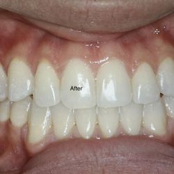 Rehil Orthodontics - After