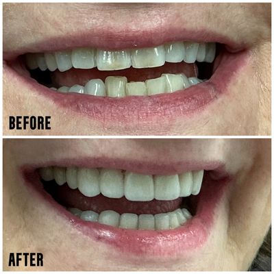 Porcelain Veneers - Dentist Steven Goldy, D.D.S., Beverly Hills CA, practices a full scope of general and cosmetic dentistry with expertise ranging from porcelain veneers to dental implants , crowns and bridges . Dr. Goldy can now correct a wide variety of so-called permanent cosmetic dental problems, and can literally redesign your smile. Porcelain Veneers - Dentist Steven Goldy, D.D.S., Beverly Hills CA, practices a full scope of general and cosmetic dentistry with expertise ranging from porcelain veneers to dental implants , crowns and bridges . Dr. Goldy can now correct a wide variety of so-called permanent cosmetic dental problems, and can literally redesign your smile.
