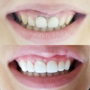 Friendly Dental Center - Crowns - General Dentistry Near Me - Newark, New Jersey