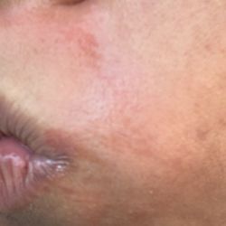 Nina's Shahnaz Herbal Salon & Spa - Day 1 - Left side of face -Wax burned my skin