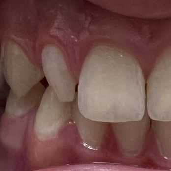 Michael Yang, DDS - Her lateral (next to the big tooth in the middle) is under-developed and misshapen. - General Dentistry Near Me - Tustin, California Michael Yang, DDS - Her lateral (next to the big tooth in the middle) is under-developed and misshapen. - General Dentistry Near Me - Tustin, California