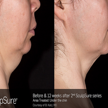 LBC Laser MD - Laser Hair Removal Near Me - Long Beach, California