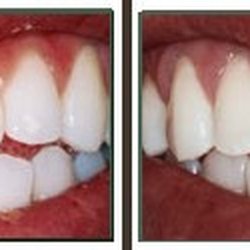 Tierrasanta Plaza Dental Care - Before_after_porcelain_veneers3