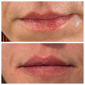 Ritz XV - Before/After lip filler - Medical Spas Near Me - Austin, Texas Ritz XV - Before/After lip filler - Medical Spas Near Me - Austin, Texas