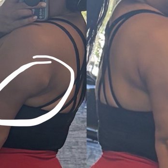 AirSculpt - Orange County - Uneven-ness on one arm vs the other even side - Body Contouring Near Me - Irvine, California AirSculpt - Orange County - Uneven-ness on one arm vs the other even side - Body Contouring Near Me - Irvine, California