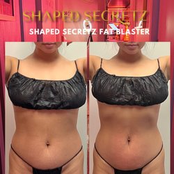 Shaped Secretz Body Sculpting - Body Sculpting Treatment - Before and After