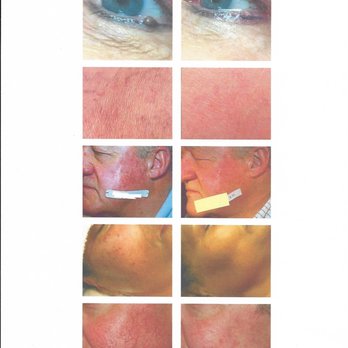 Beautifully Balanced Skincare - ThermoClear treats epidermal imperfections in seconds! - Skin Care Near Me Beautifully Balanced Skincare - ThermoClear treats epidermal imperfections in seconds! - Skin Care Near Me