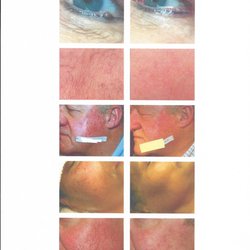 Beautifully Balanced Skincare - ThermoClear treats epidermal imperfections in seconds!