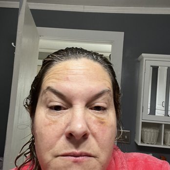 Rockmore Plastic Surgery - Filler catastrophe - Cosmetic Surgeons Near Me - Latham, New York