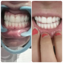 Davinci Teeth Whitening - From my 2nd session with Donna! My teeth went from between a 1 and 2 and whitened to a -1 or a -2. I LOVE her work!
