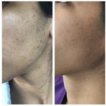 Mindykim Skincare - 6 months in - Skin Care Near Me - Miami, Florida Mindykim Skincare - 6 months in - Skin Care Near Me - Miami, Florida