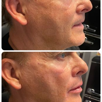Body By Rx - We specialize in keeping men looking masculine and natural with botox and dermal fillers like Juvederm. Here we added cheek and lip filler - Weight Loss Centers Near Me - Mesa, Arizona