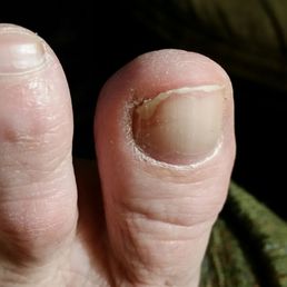2 weeks after my pedi I trimmed my nails and removed the polish to find something that looks like nail fungus. 2 weeks after my pedi I trimmed my nails and removed the polish to find something that looks like nail fungus.