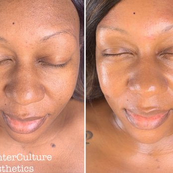 Counter Culture Esthetics - Dermaplane Facial - Skin Care Near Me - Phoenix, Arizona Counter Culture Esthetics - Dermaplane Facial - Skin Care Near Me - Phoenix, Arizona