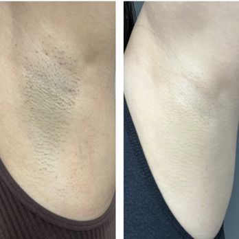 Via Laser - Underarms candela laser hair removal - Medical Spas Near Me - Las Vegas, Nevada Via Laser - Underarms candela laser hair removal - Medical Spas Near Me - Las Vegas, Nevada