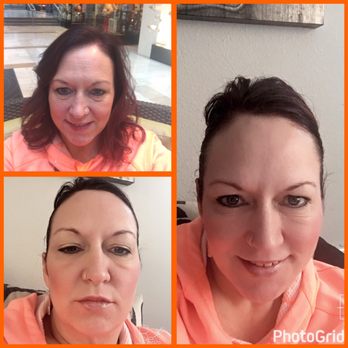 Egrari Plastic Surgery Center - This was the day of and then the day after. - Skin Care Near Me - Bellevue, Washington Egrari Plastic Surgery Center - This was the day of and then the day after. - Skin Care Near Me - Bellevue, Washington