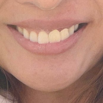 CDIC Dental - this picture is taken far way and u still can see the white line on my gum, 2 shade more yellow. 10 x worse in reality - Periodontists Near Me - Huntington Beach, California