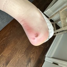 Ankle