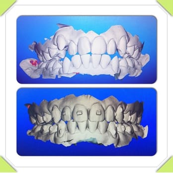 Palmer Orthodontics - Begin part two - finishing touches! - Orthodontists Near Me - Boynton Beach, Florida
