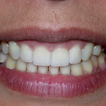 Gevik Marcarian, DDS - After Veneers - Cosmetic Dentists Near Me - Encino, California Gevik Marcarian, DDS - After Veneers - Cosmetic Dentists Near Me - Encino, California