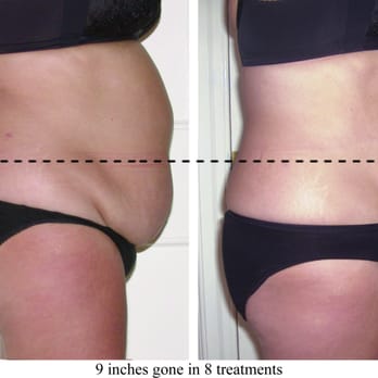 Magnificat Wellness Center - Get great results with our Vevazz laser-like lipo machine! - Medical Spas Near Me - Spring, Texas Magnificat Wellness Center - Get great results with our Vevazz laser-like lipo machine! - Medical Spas Near Me - Spring, Texas