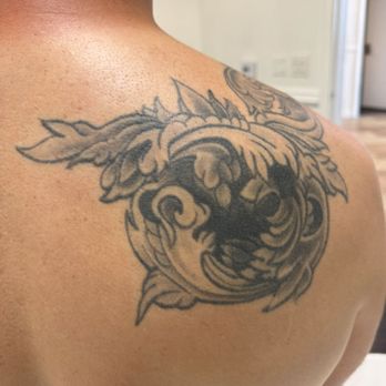 MS Slim - Big cover up that I'm getting removed - pre first visit - Skin Care Near Me - Irvine, California