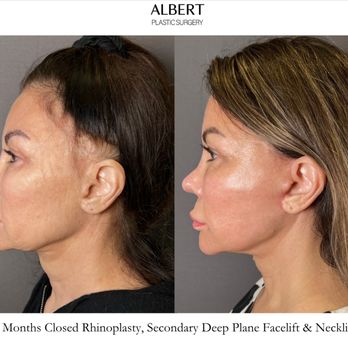 Mark G Albert, MD - Closed Rhinoplasty, Secondary Deep Plane Face Lift & Neck Lift - Cosmetic Surgeons Near Me - New York, New York