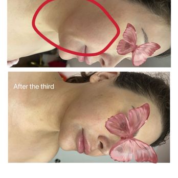 Yuyan Beauty - Definitely Go --- Ice Resculpting facial! - Eyelash Service Near Me - Pasadena, California Yuyan Beauty - Definitely Go --- Ice Resculpting facial! - Eyelash Service Near Me - Pasadena, California