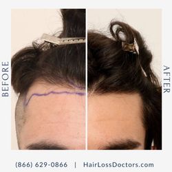 The Hair Loss Doctors - Male Before / After Sample from The Hair Loss Doctors By Robert J. Dorin with Surgical Headquarters in Garden City, NY.