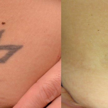 Blink Tattoo Removal - Tattoo Removal Near Me - Seattle, Washington