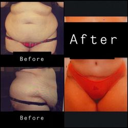 Charles T Longo, MD - Tummy Tuck and lipo