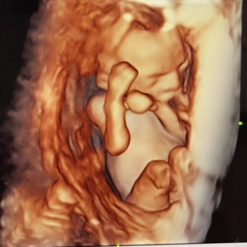 Image N You Ultrasound Studio - Baby cuddled up in the uterus :) 3D ultrasound - Ultrasound Imaging Centers Near Me - Carson, California Image N You Ultrasound Studio - Baby cuddled up in the uterus :) 3D ultrasound - Ultrasound Imaging Centers Near Me - Carson, California