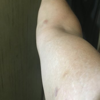 Sacramento Protective Services - My right arm after assault by with SPS on 5/19/22. I'm going to go to PT through the VA for my right shoulder. - Security Services Near Me Sacramento Protective Services - My right arm after assault by with SPS on 5/19/22. I'm going to go to PT through the VA for my right shoulder. - Security Services Near Me