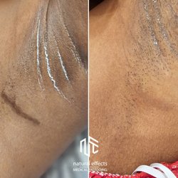 Natural Effects Medical Tattooing