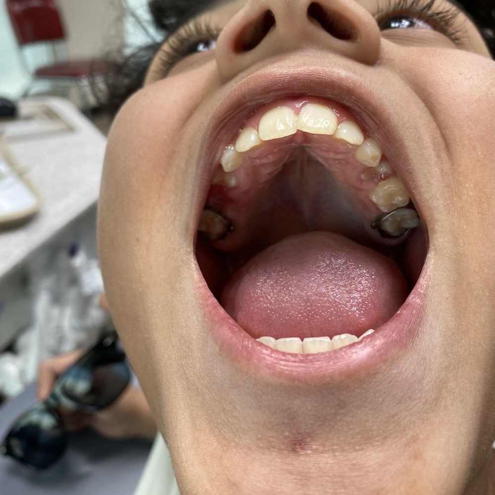 Braceland Orthodontics - After the expander was taken out. - Orthodontists Near Me - San Antonio, Texas