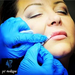PV MediSpa - Lip flip, Xeomin (Botox)