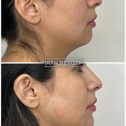 Raw Beauty Aesthetics - Chin Filler with Neck Slimming