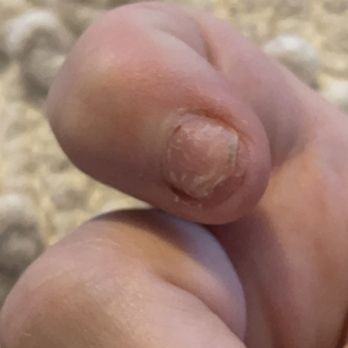 LT Nails - This nail bed shows the fungus - this nail was the most infected. - Nail Salons Near Me - Grove City, Ohio