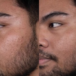 Aloha Med Spa - SkinVive at Aloha MedSpa (2 Week Before & After)