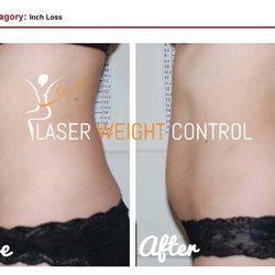 Laser Weight Control