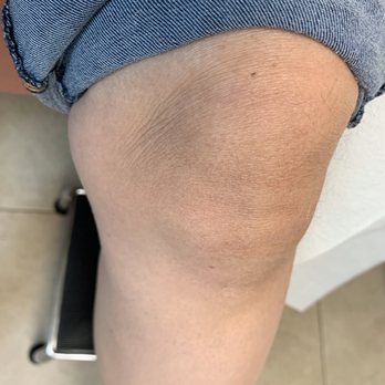 Select Physical Therapy - Tamarac - My left knee, 9/19/19 - Physical Therapy Near Me - Tamarac, Florida
