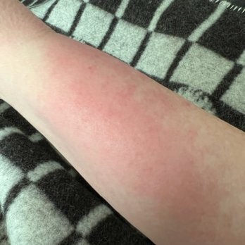 Rejuvenation and Well Being - Burning Rash - Nutritionists Near Me - Cotati, California Rejuvenation and Well Being - Burning Rash - Nutritionists Near Me - Cotati, California