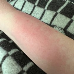 Rejuvenation and Well Being - Burning Rash