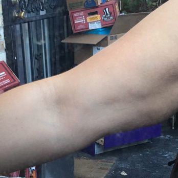 Purely You - This is how my left arm looks from the front. It is much larger compared to my right arm. - Weight Loss Centers Near Me - Aurora, Colorado